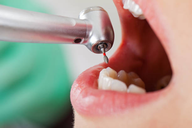 Best Emergency Root Canal Treatment in Slater, MO